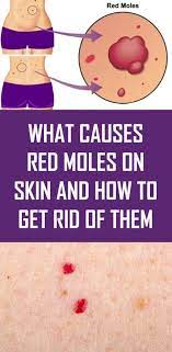 What Causes Red Moles On Skin And How To Get Rid Of Them Red Moles Skin Moles Moles On Face