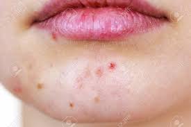 Young Woman Showing Her Face With Acne And Moles Dry Lips Teen Stock Photo Picture And Royalty Free Image Image 128769864