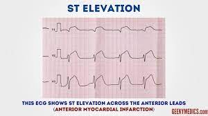 How To Read An Ecg Ecg Interpretation Ekg Geeky Medics