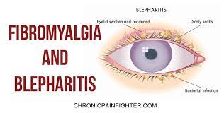 Alas Fibromyalgia Comes With An Endless List Of Symptoms You Might Think That Fibromyalgia Will Not Affect Your Blepharitis Fibromyalgia Fibromyalgia Causes