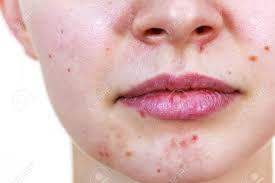 Young Woman Showing Her Face With Acne And Moles Dry Lips Teen Stock Photo Picture And Royalty Free Image Image 119125713