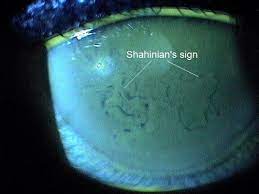 These defects are spots of missing epithelial cells that fall off easily because of the edell e, woodward ma, bunya v. H18 59 Anterior Corneal Dystrophies Decision Maker Plus