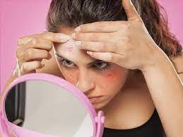 Toothpaste For Pimples How To Use Toothpaste For Removing Pimples Lifealth