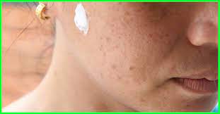 Toothpaste On Pimples Why You Should Avoid It