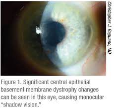 It is characterized by the development of clusters of multiple. When And How To Treat Ebmd