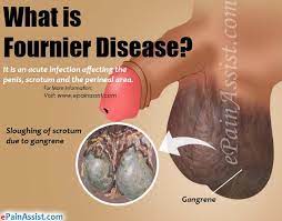 What are symptoms fournier's gangrene. Fournier Disease Causes Symptoms Treatment Diagnosis