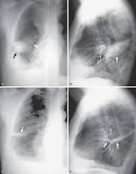 The left lung is almost. Pleural Effusion Radiology Key
