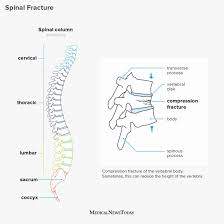 The break statement has two forms: Broken Back Symptoms Treatment And Recovery