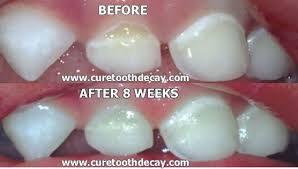 Despite The Myths Sugar And Bacteria Aren T The Real Culprits That Cause Tooth Decay Learn The Real Cause Baby Bottle Tooth Decay Heal Cavities Teeth Health