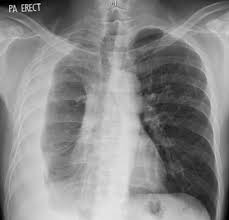 The left lung is almost. Clinical Vignette 27 Miphidic