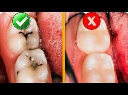 8 Simple Ways To Naturally Heal Tooth Decay And Reverse Cavities Youtube Tooth Decay Tooth Decay Remedies Dental Decay