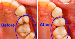 10 Health Benefits Of Oil Pulling Whiten Teeth Improve Bad Breath Gums Oral Hygiene Heal Cavities Tooth Decay Oral Health