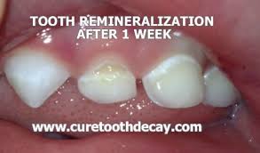 Photographic Proof Of Remineralized Cavities Healthy Home Economist Cure Tooth Decay Tooth Decay Treatment Heal Cavities