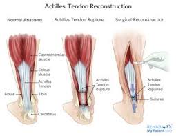 The tendon's position in the body puts it under a lot of strain, especially during exercise. Achilles Tendon Repair Physiopedia