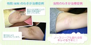 わきが 多汗症治療ならリオラビューティークリニック 千葉県柏 上野の美容外科 美容皮膚