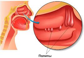 Polipy V Nosu Chto Eto Takoe Simptomy Prichiny Diagnosti Lechenie