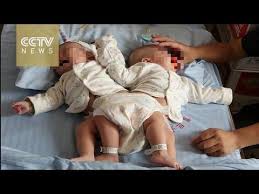 Chinese Conjoined Twins Separated With 3d Technology Youtube Conjoined Twins 3d Printing Technology Twins
