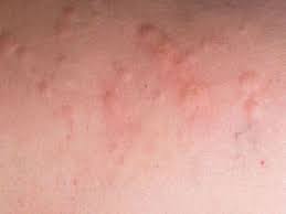 Syp Na Kozhe Soprovozhdayushayasya Zudom I Bolevymi Oshusheniyami O Chem Govorit Simptom Kak Dermatologi Diagnostiruyut Bolezn Sredstva I Sposoby Lecheniya