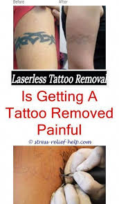 Entfernung Von Lasertatowierungen Essex Can Entfernung Von Tatowierungen Gefahrlich Sein Wie Tattoo Removal Laser Tattoo Tattoo Removal Cost