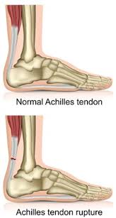 Achilles tendinitis is inflammation of the achilles tendon. Achilles Tendon Rupture Tear Southern Cross Nz