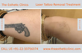 Although, you might be surprised what your tattoo artist can complete within an hour. Tattoo Removal Mumbai Permanent Laser Tattoo Removal Treatment Cost India The Esthetic Clinics