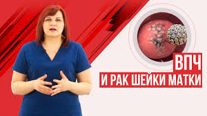 Vpch Lechit Ili Net Rak Shejki Matki I Virus Papillomy Cheloveka Youtube