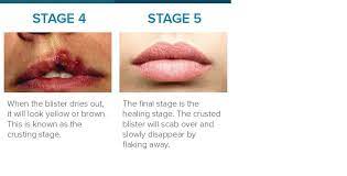 Cold Sore Stages Identification And Treatment