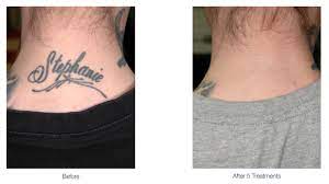 After all, for tattoo removal laser treatment is the best tattoo removal methods. Laser Tattoo Removal Plastic Surgeon Parbhu Oculofacial Plastic Surgery