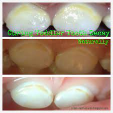 First I Want To Start Off By Saying That I Believe That Every Situation That Comes My Way Is One To Toddler Tooth Decay Tooth Decay Remedies Baby Tooth Decay