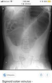 Volvulus Coffee Bean Sign Medical Sigmoid Colon Pathology