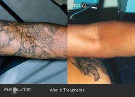 The main one being how long will it take and will the tattoo completely go. Laser Tattoo Removal Before And After 8 Treatments Laser Tattoo Laser Tattoo Removal Laser Removal