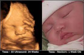3d Ultrasound Photo Side By Side Comparison To My Actual Newborn Baby I Would Have Loved This From Someone Else D 3d Ultrasound Baby Ultrasound Ultrasound