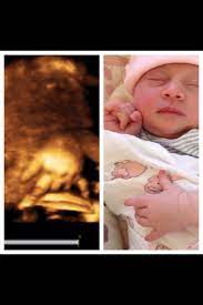 Before And After Pictures From Your 4d Ultrasounds Show Just How Accurate These Images Really Are 4d Ultrasound Ultrasound Spiderman Art