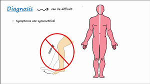 Call 999 for an ambulance or go to. Guillain Barre Syndrome Gbs Described Concisely Youtube