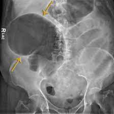 Usmle Pathology Slides Pathology Abdominal Distension Human Body Anatomy