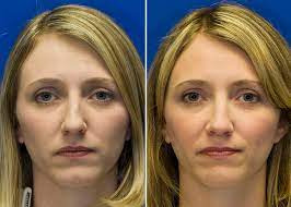 An alar spreader graft then was used to support the lateral crus until a biologic scar cast was formed. Spreader Grafts Rhinoplasty In Seattle Rhinoplasty Surgeon
