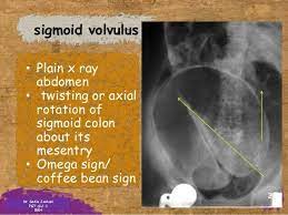 Vovolus Bowel Git Sigmoid Colon Coffee Signs Git