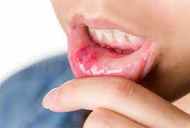 Mouth Ulcers And Canker Sores Treatment Symptoms Causes Remedies
