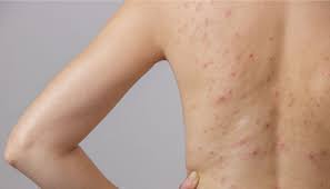 Pryshi Na Spine I Plechah Prichiny Poyavleniya I Metody Lecheniya My Izumrud Hair Beauty Health Beauty