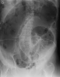 The Coffee Bean Sign Also Known As Bent Inner Tube Sign Is A Sign On An Abdominal Plain Film Of A Sigmoi Radiology Radiology Imaging Small Bowel Obstruction