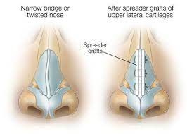 Find out the meaning of this term. Spreader Graft Cosmetic Surgeon Brisbane Dr Raymond Goh Plastic Surgeon Specialising In Cosmetic Reconstructive And Hand Surgery Brisbane