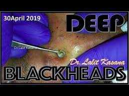 (however, if you are removing your own blackhead—because let's be real, we all get them—this is how to do it correctly.) in addition to the video that made 22 million stomachs queasy ps: Deep Blackhead Removal By Dr Lalit Kasana 30 April 2019 Youtube