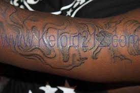 How much does laser removal cost in los angeles. Tattoo Keloid Cream Tattoo Design
