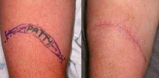 Yes he removed his tattoos because the tattoos represented something negative. Blog Spot Tatt Chat City Tattoo Removal