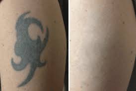The energy from the laser. Tattoo Removal With The Picosure Laser The Spa At Spring Ridge