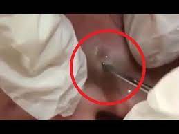 It's kind of safe to say that if you have a sensitive stomach or a big lunch, the below videos probably aren't for you. Blackheads Removal 55 Best Pimple Popping Videos 2019 Youtube Honey Face Cleanser Makeup Life Hacks Pimple Popping