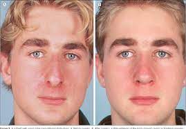 Spreader grafts are strips cartilage made of patients own cartilage that are placed on each side of the septum ( between the septum and the side wall). Pdf The Effect Of Spreader Grafts On Nasal Dorsal Width In Patients With Nasal Valve Insufficiency Semantic Scholar