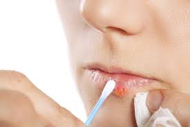 Cold Sore Remedies How To Treat And Prevent Cold Sores On Your Lips Allure