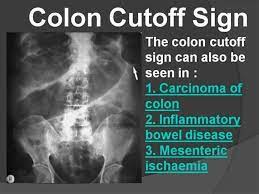 Colon Cutoff Sign Xray Abdomen Radiology Radiology Imaging Medical Mnemonics