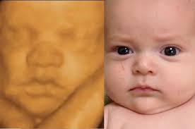 Before After Photo Gallery Baby Ultrasound Ultrasound 3d Ultrasound